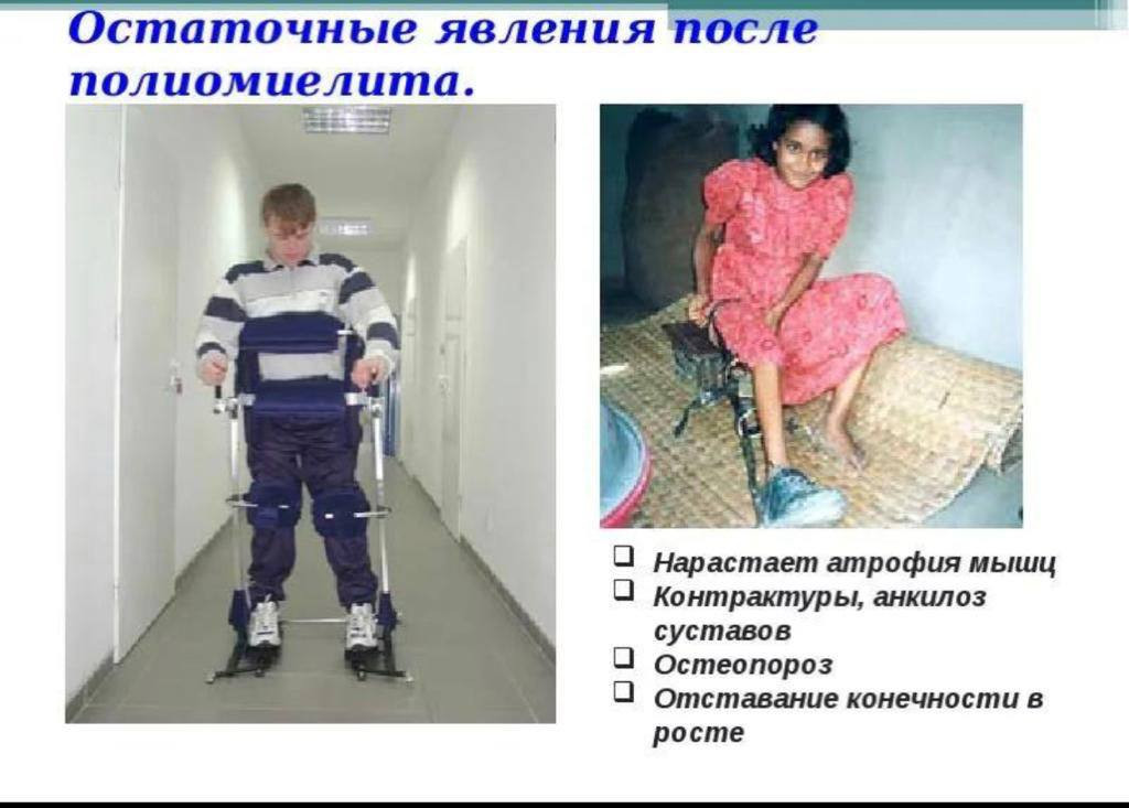 Полиомиелит