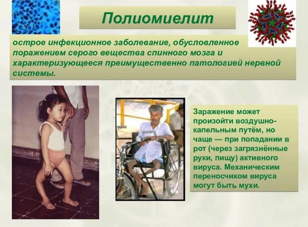 Полиомиелит